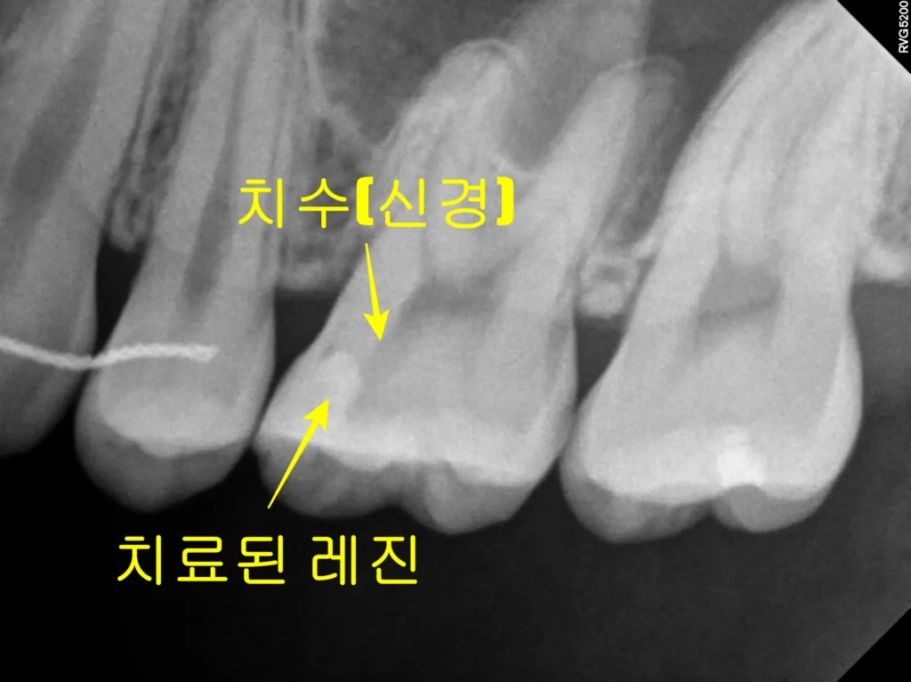 유학생 신경치료 초진 P.A view(#26)