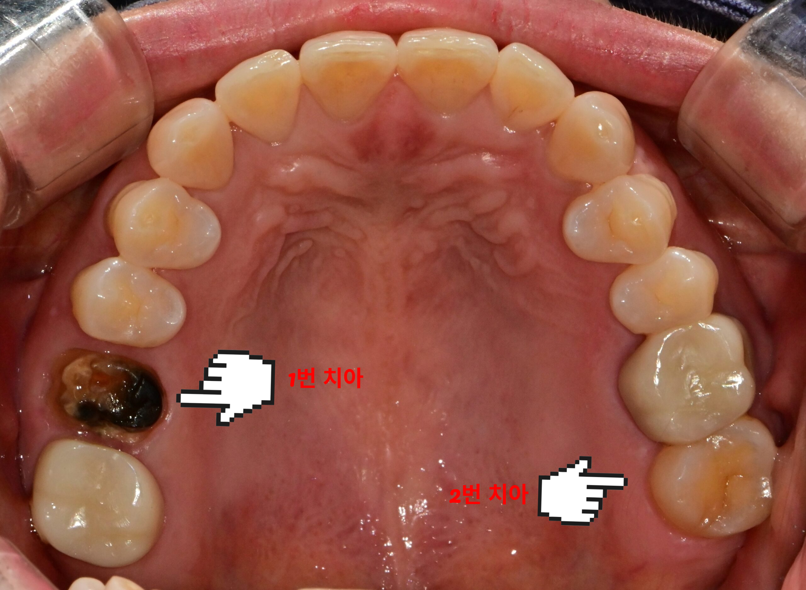 타치과에서 발치 판정을 받은 치아 #16과 씹을 때 통증을 호소하는 #27 치아