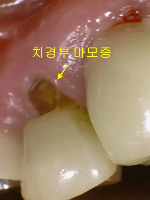치경부 마모증 치료 전 사진