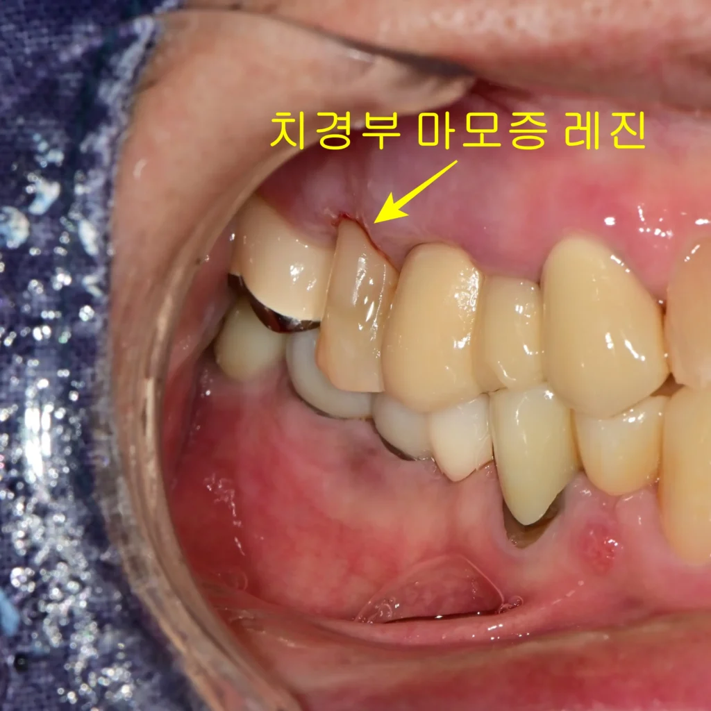 치경부 마모증 치료 후 사진