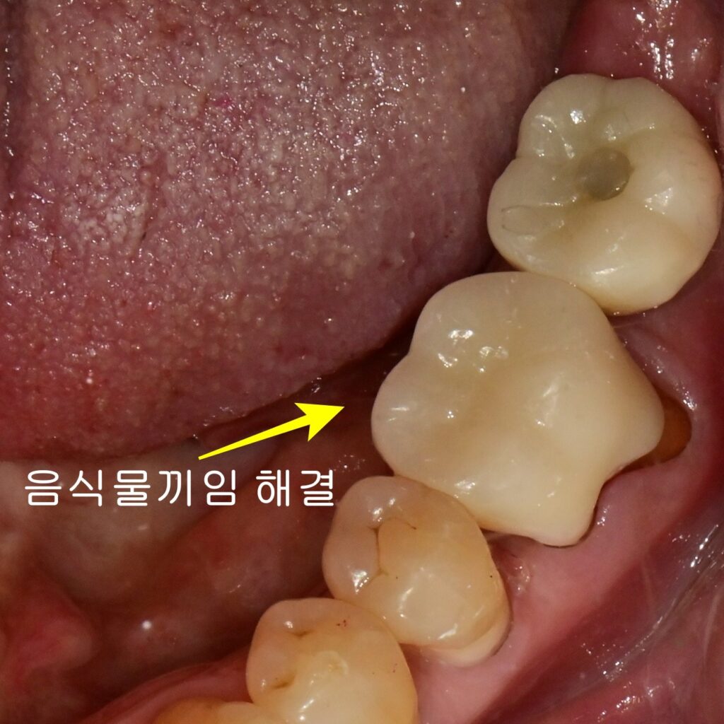 Re-crown으로 음식물 끼임 해결