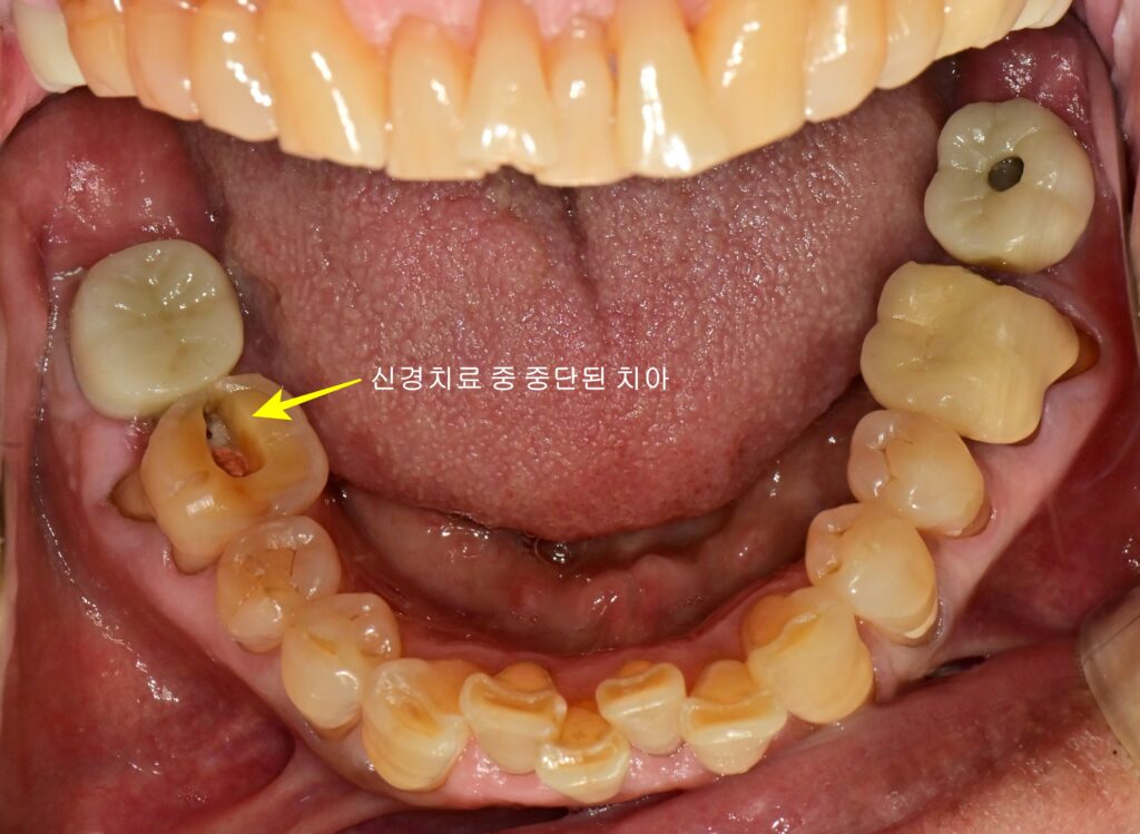 초진 구강 내 사진(하악)