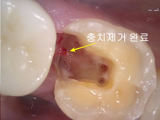 충치 제거 후