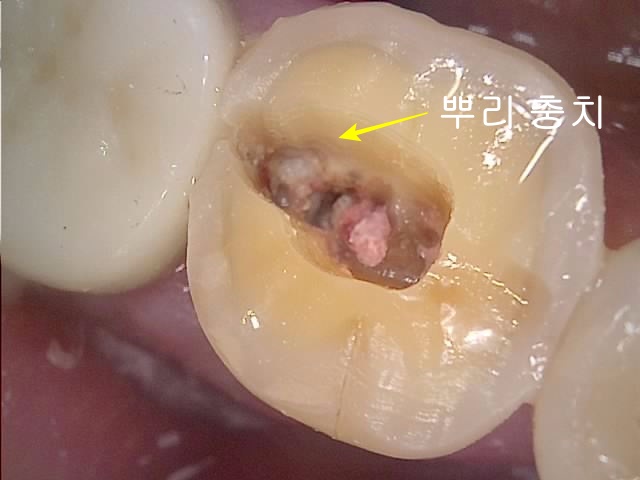 충치 제거 하는 과정