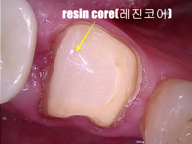 레진 코어 후 크라운 치료를 위해 치아 삭제