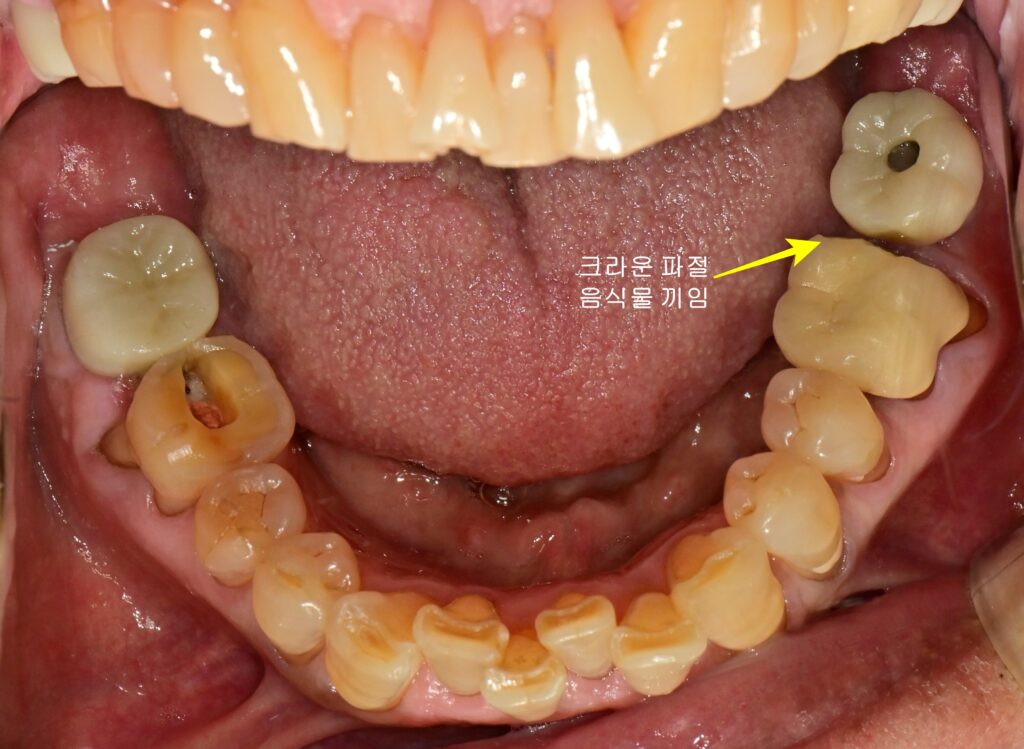음식물 끼임 초진 사진(하악)