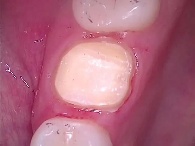 유학생 신경치료 후 크라운 삭제 모습