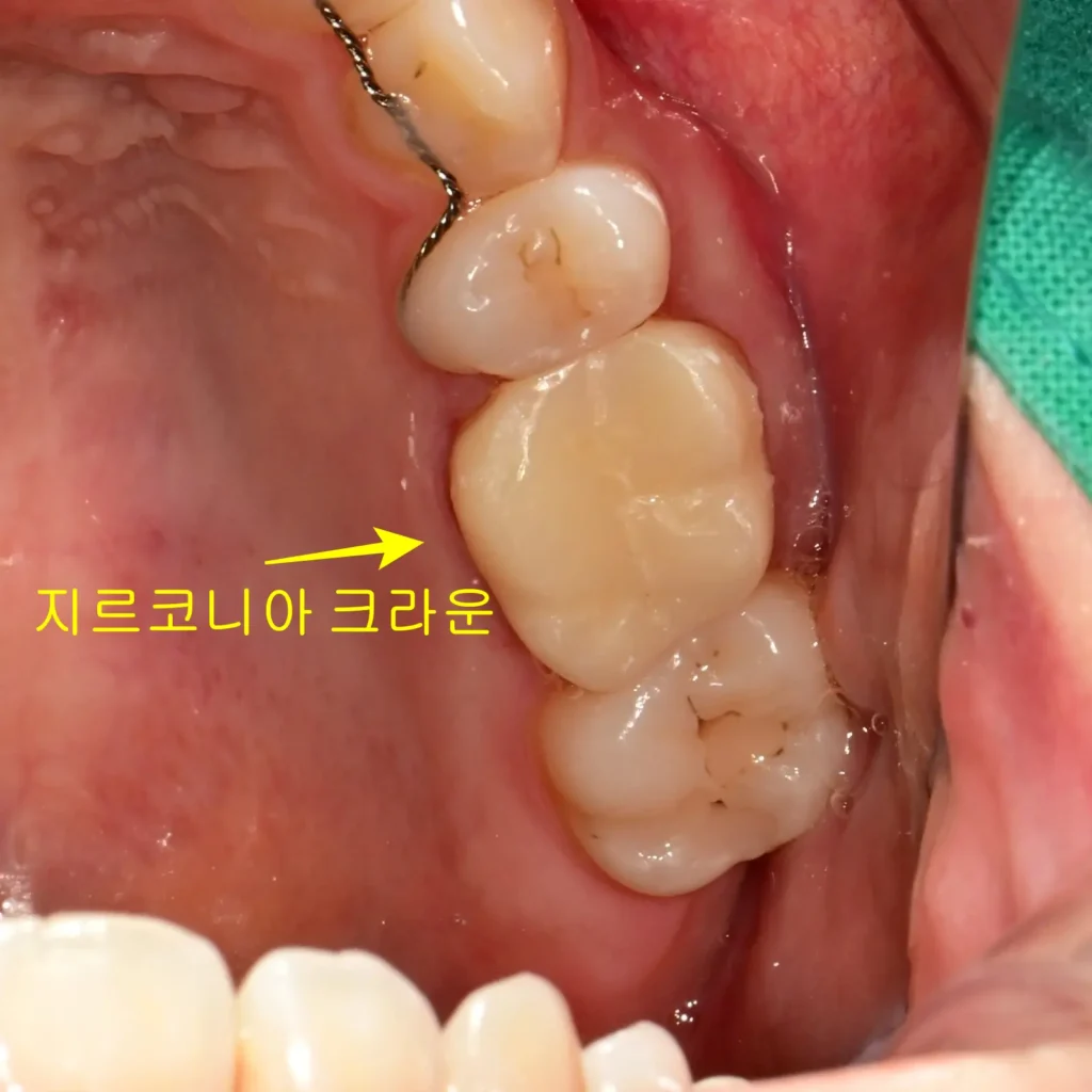 유학생 신경치료 크라운 세팅 후