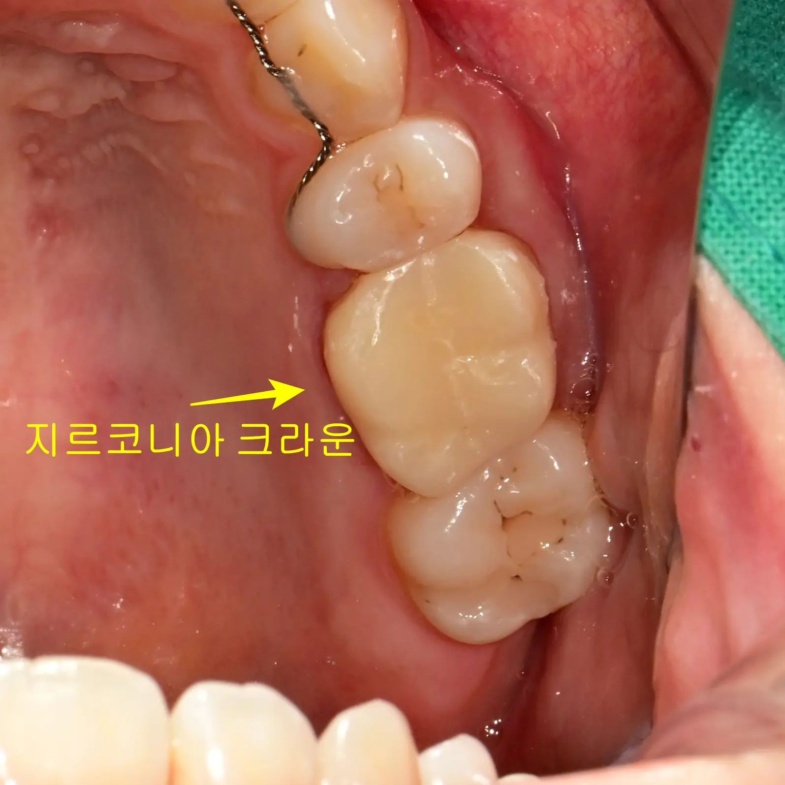 유학생 신경치료 크라운 세팅 후