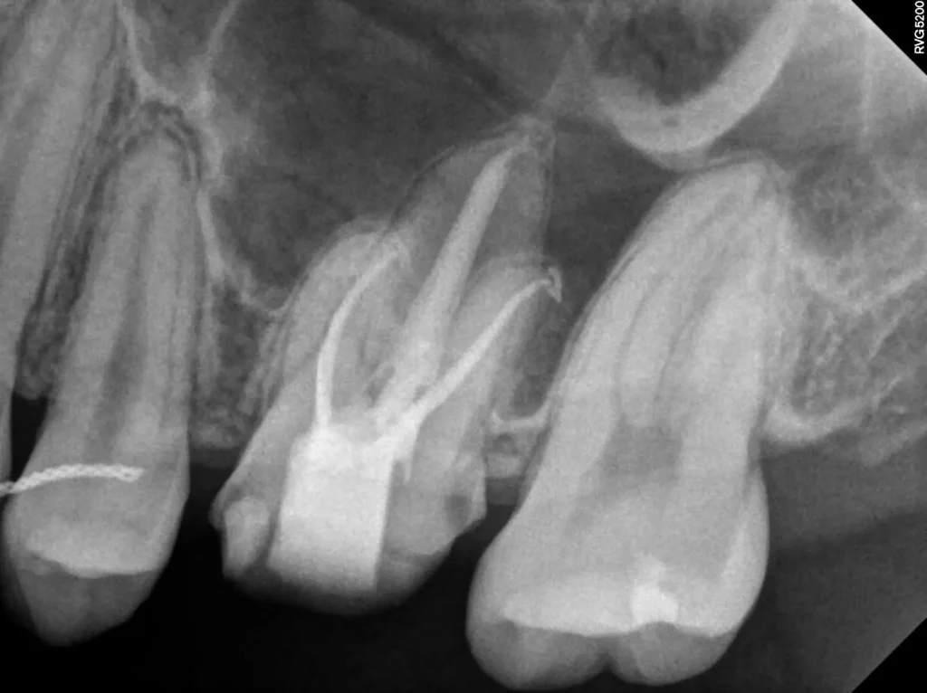 유학생 신경치료 후 P.A view(#26)