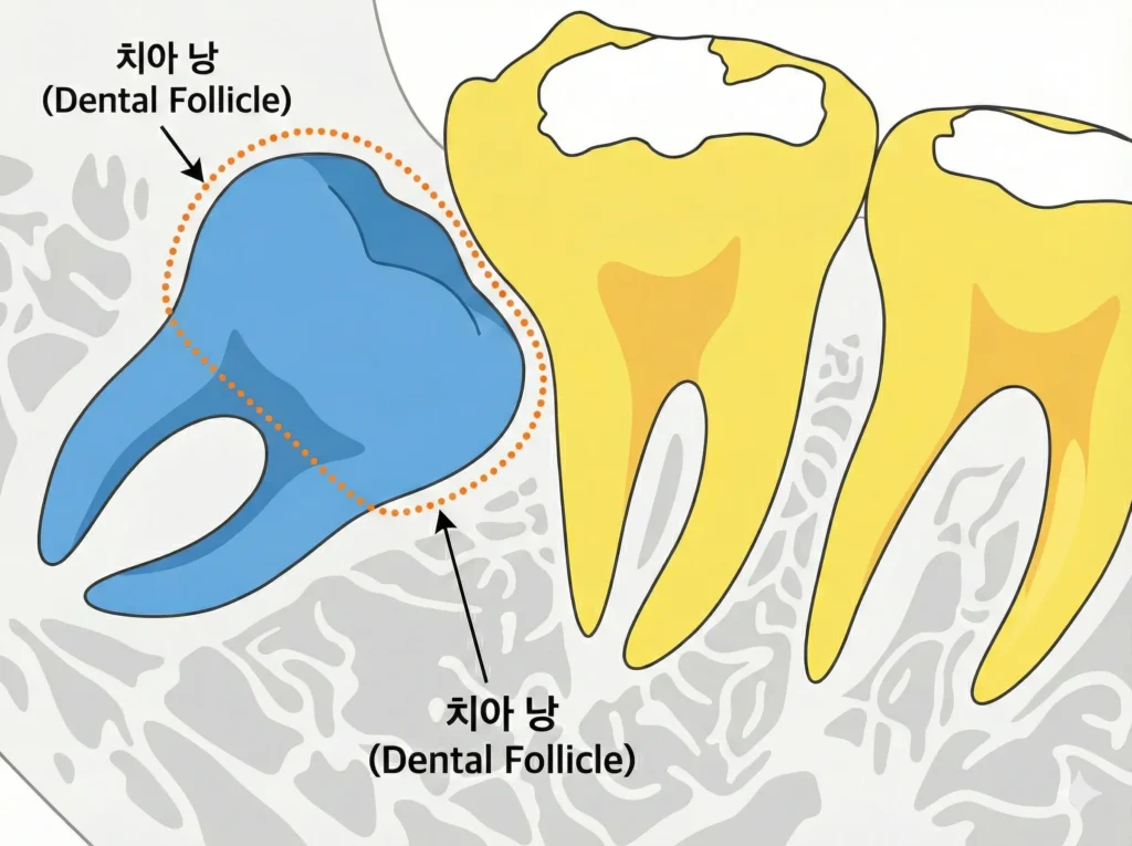 사랑니 치아낭 모식도 