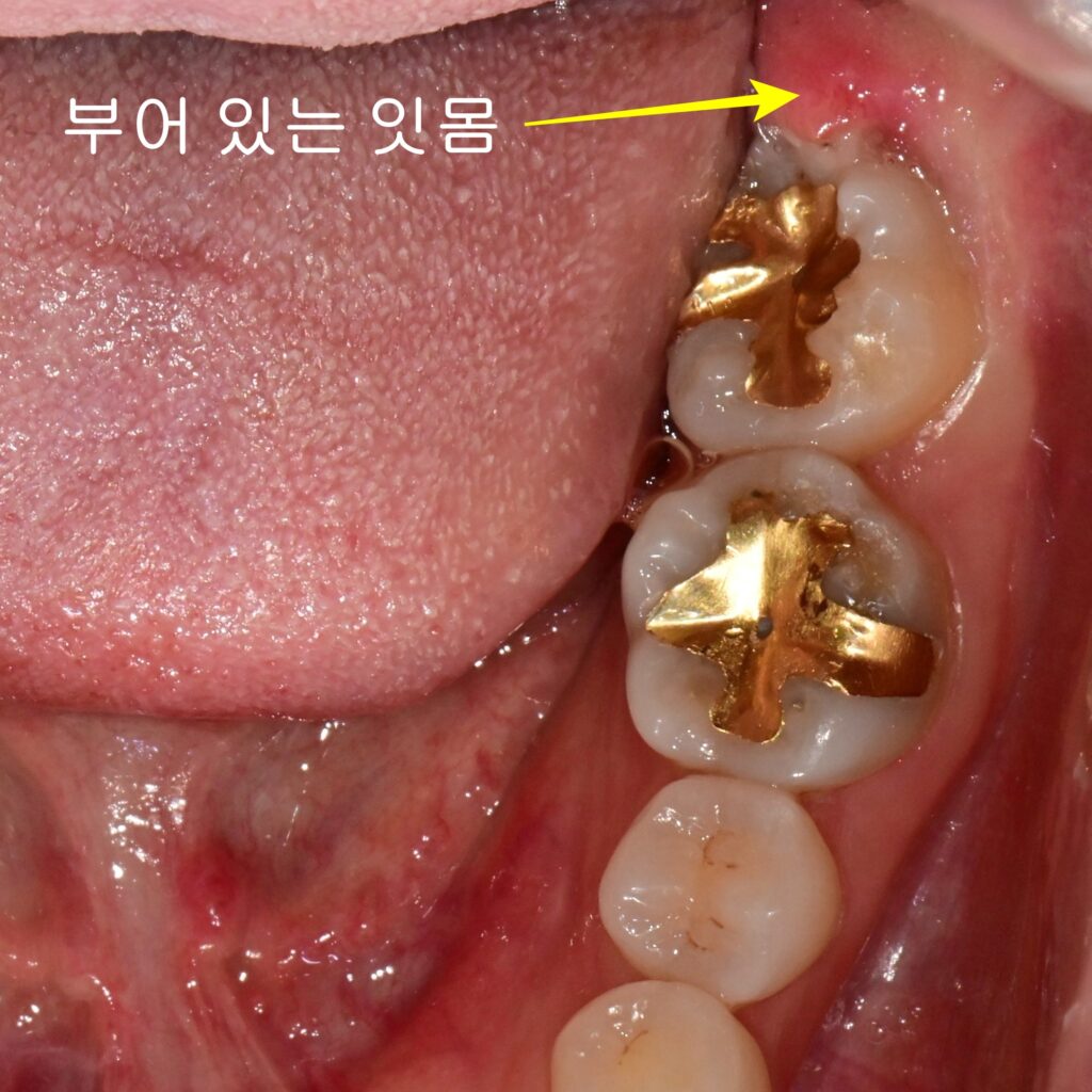 왼쪽 아래 사랑니가 부어 있는 모습
