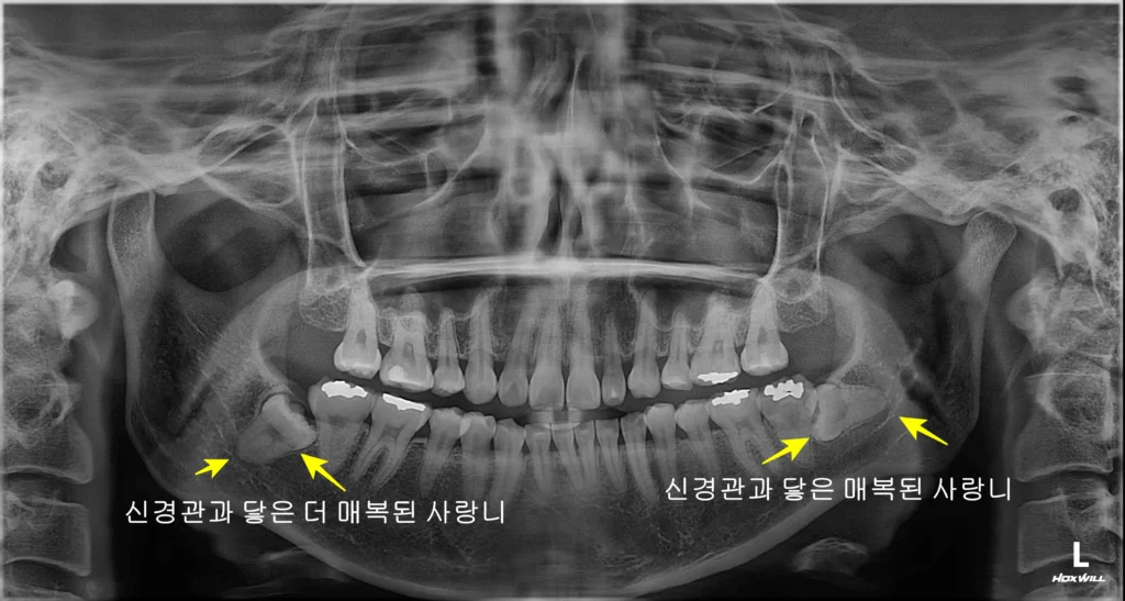 수면 사랑니 발치 초진 파노라마