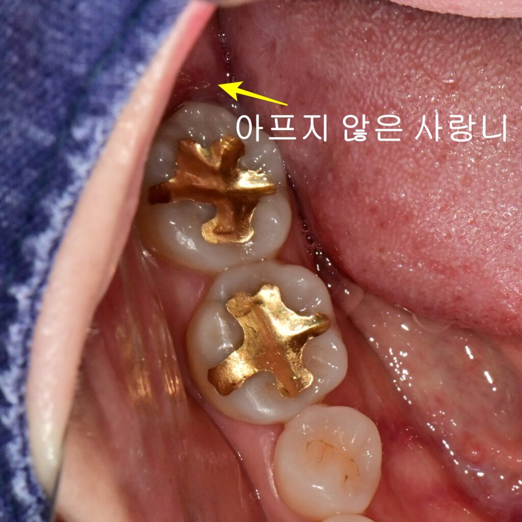 오른쪽 사랑니 구강내 모습