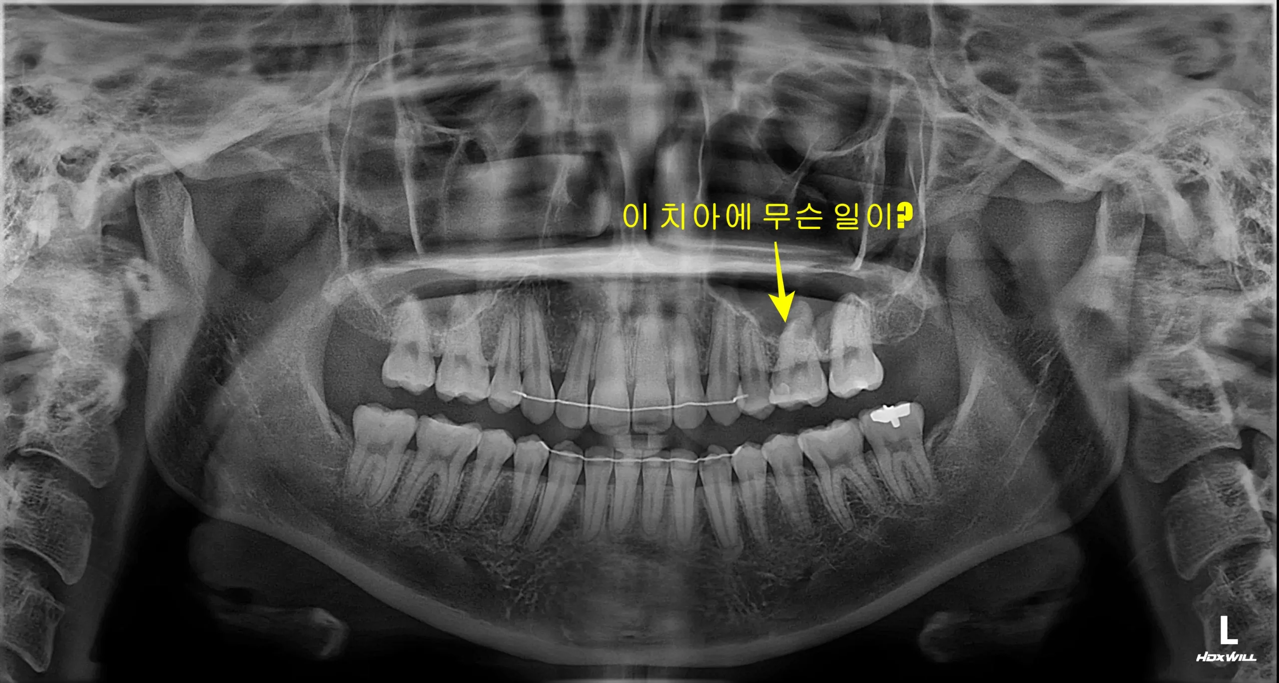 유학생 신경치료 초진 파노라마