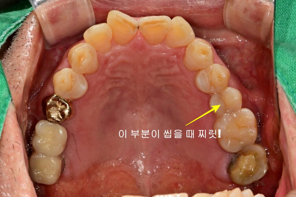 치아균열증후군 교합면 초진 사진(상악)