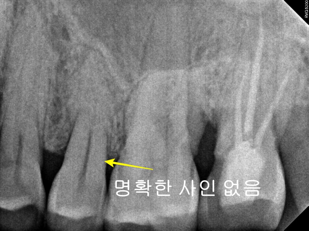 치아균열치아 Periapical view
(특이점 없음)