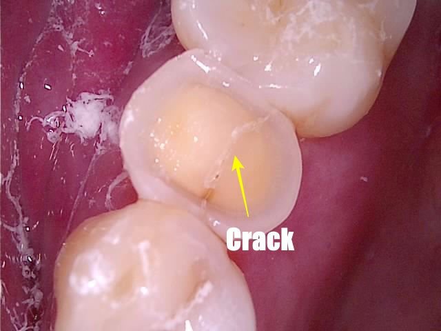 치아균열증후군 치아에서 균열 확인