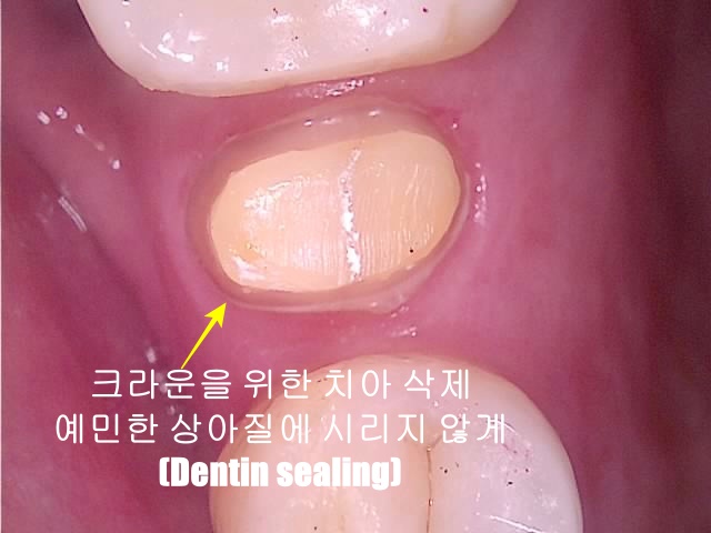 치아균열증후군 치아 신경치료 없이 크라운 치료를 위한 치아 삭제 모습