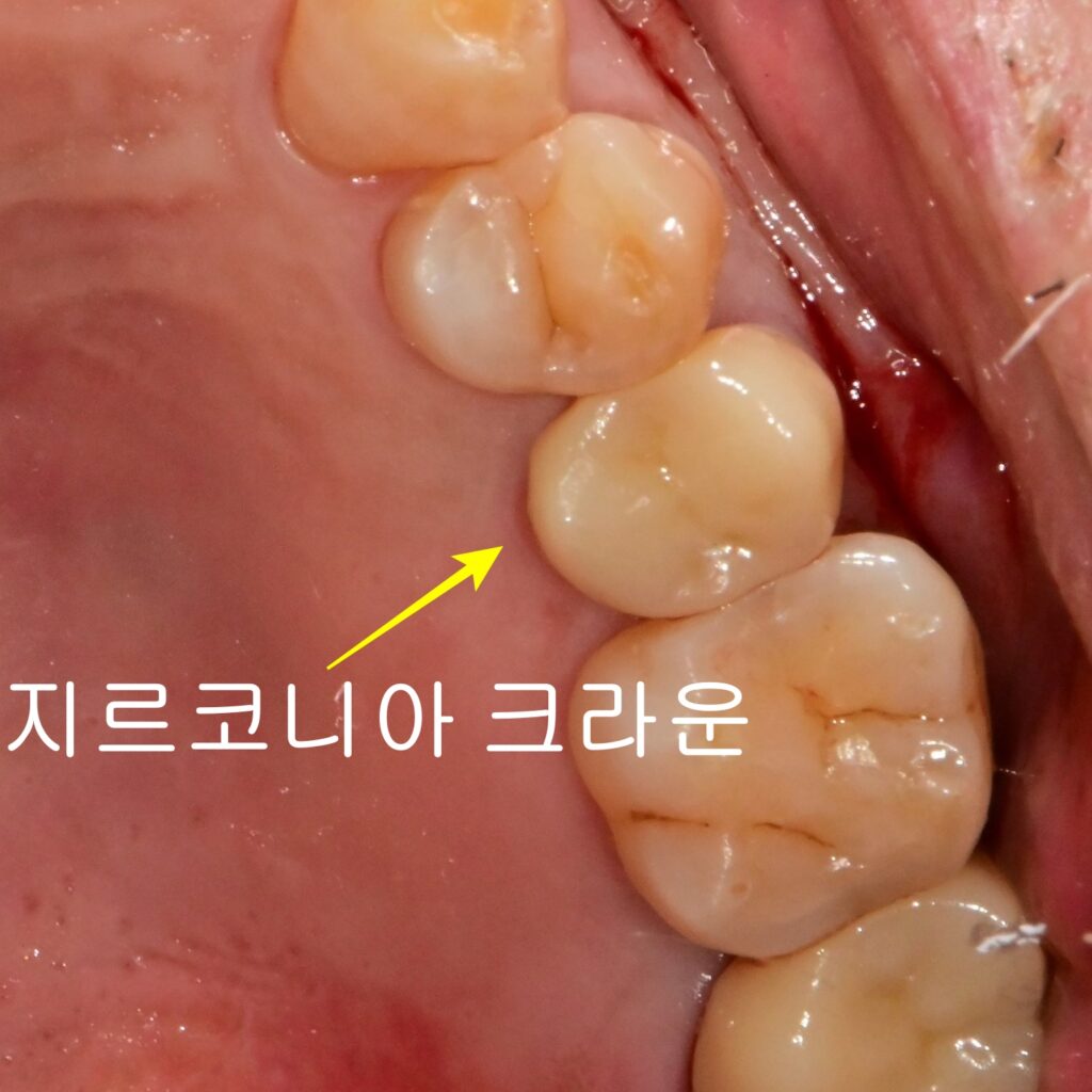치아균열증후군치아 신경치료 없이 크라운 세팅 후