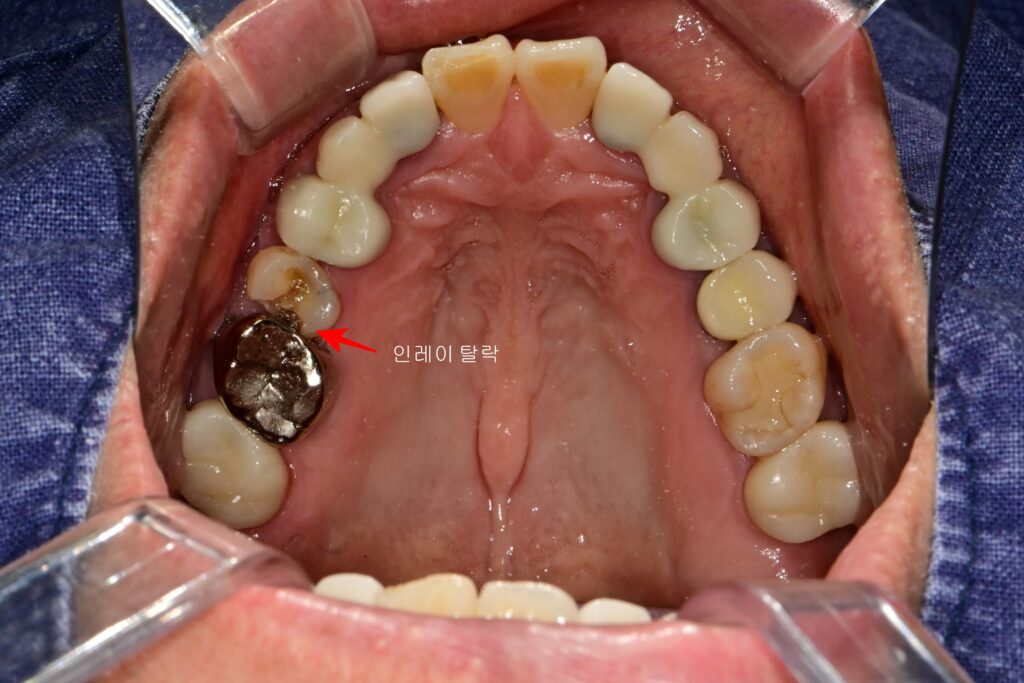 인레이 탈락 환자 초진 상악 교합면 사진