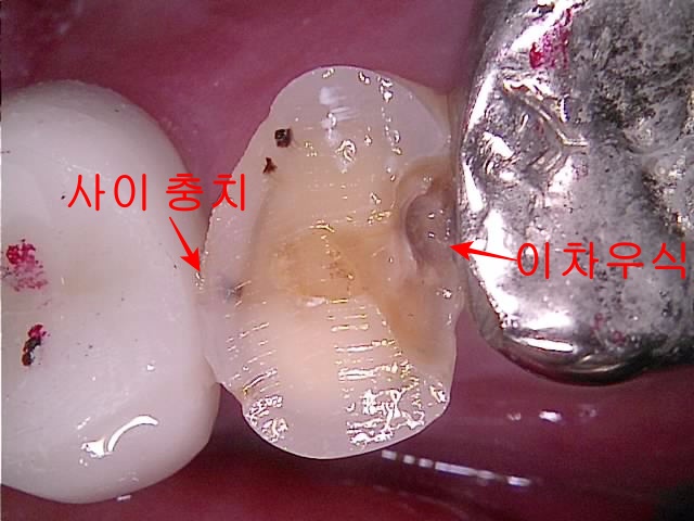 치아 삭제 중 발견된 이차우식과 치아사이충치(치료해야 하는 면적이 치아 머리의 2/3가 넘어 크라운 치료 필요함)