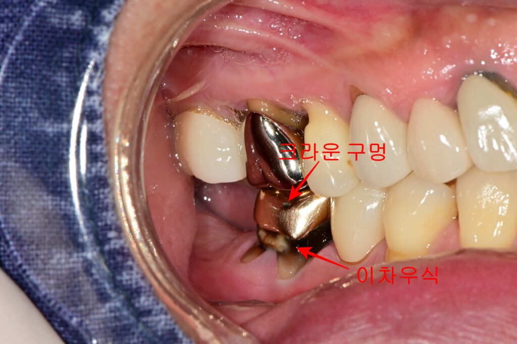 오래된 금 크라운에 hole이 생김. 하부에 이차우식이 진행