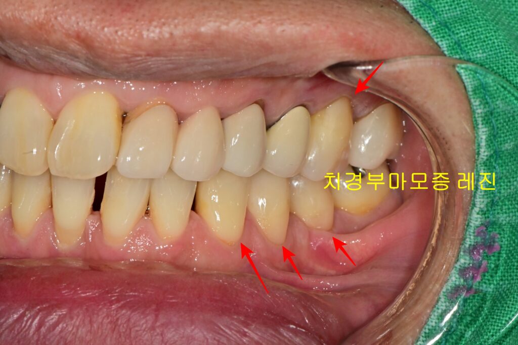 치경부 마모증 레진 치료 후