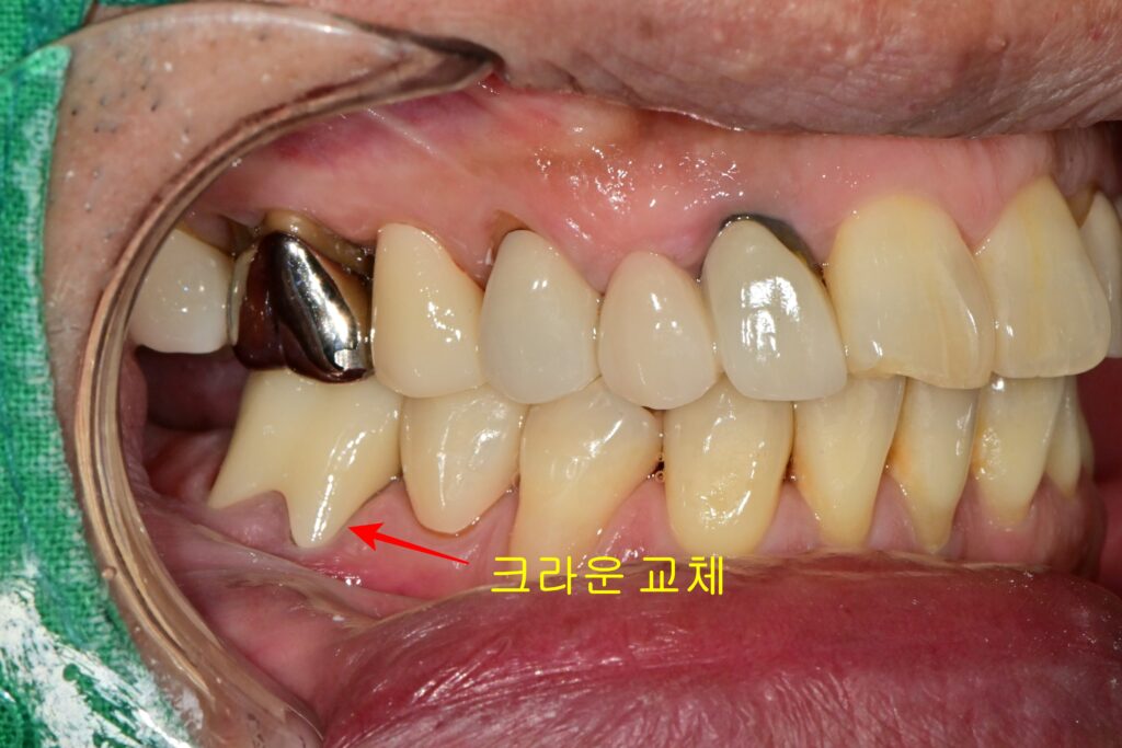 크라운교체 후