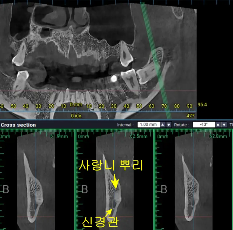 교정 중 사랑니 #38 CT 분석