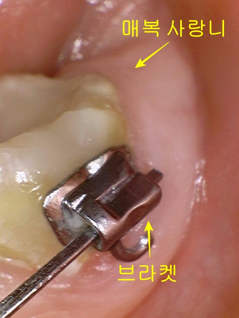 교정 중 사랑니 발치 왼쪽 하악 사랑니 구강 내 사진