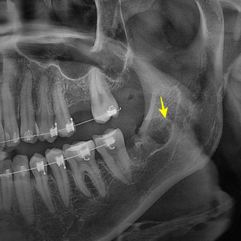 교정 중 사랑니 발치 후 파노라마