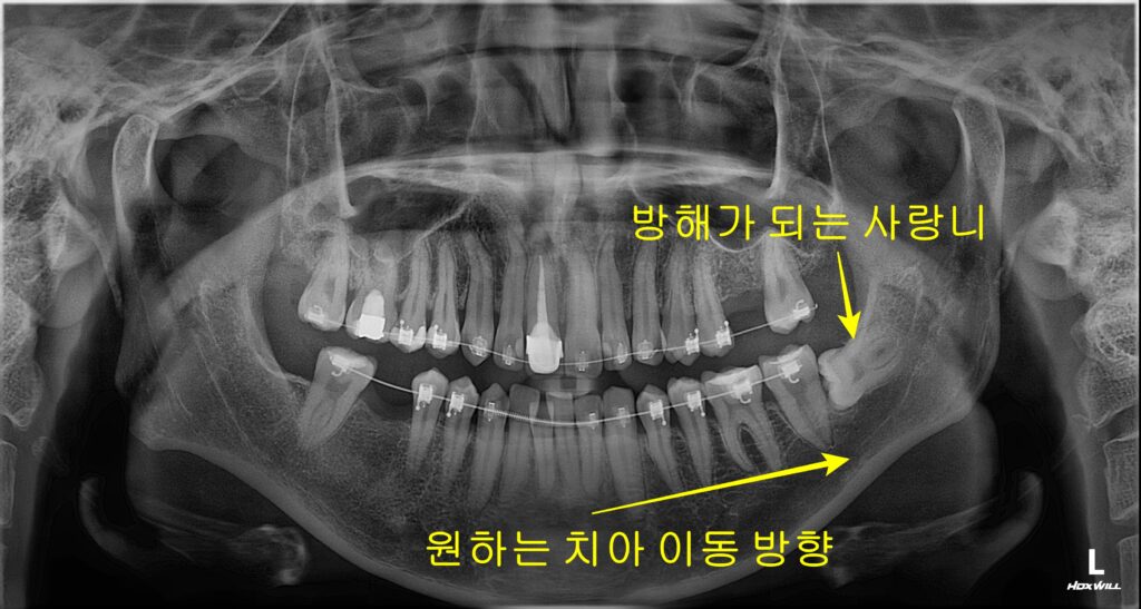 교정 중 사랑니 발치 초진 파노라마