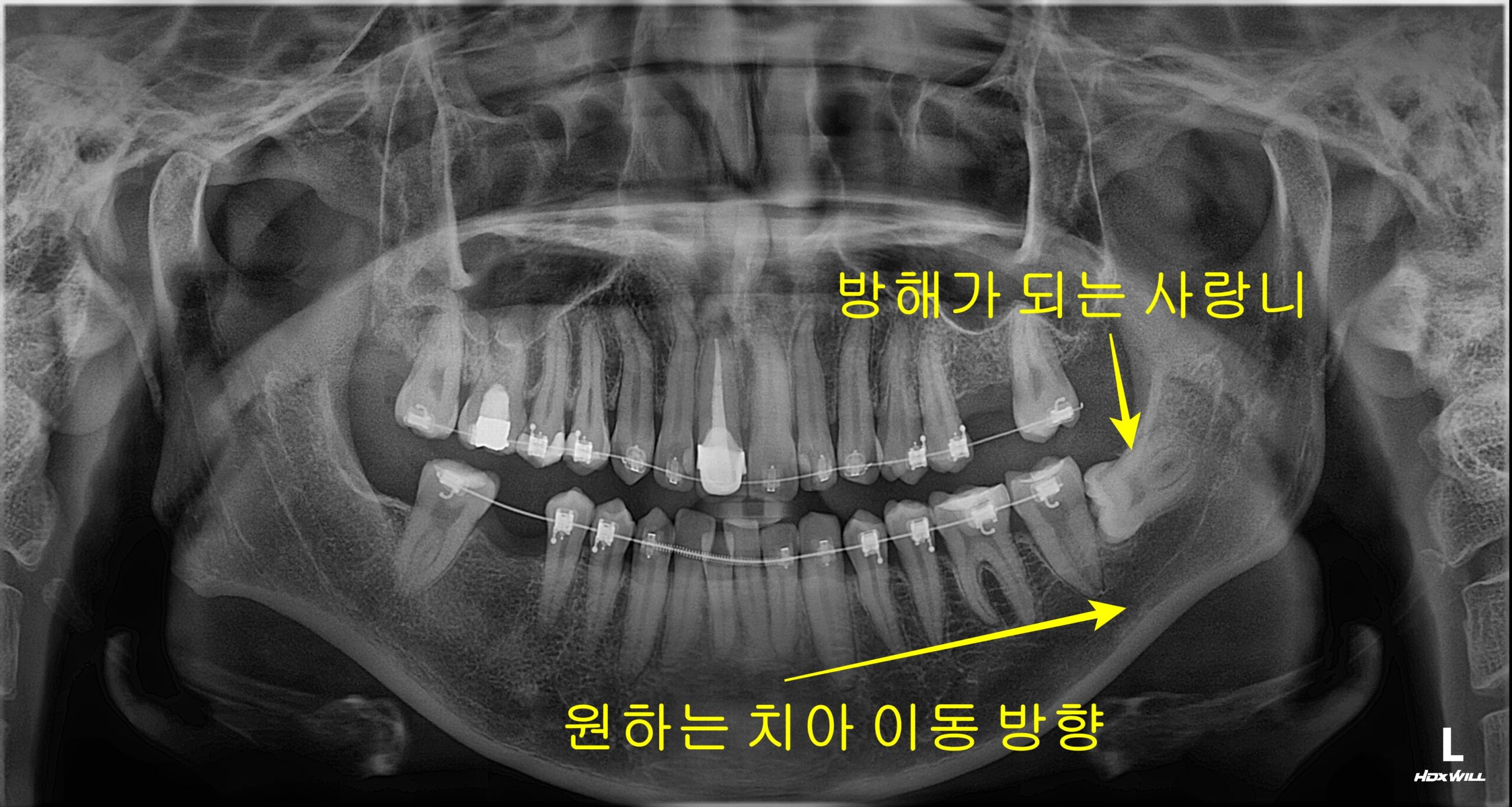 교정중 사랑니 발치 초진 파노라마
