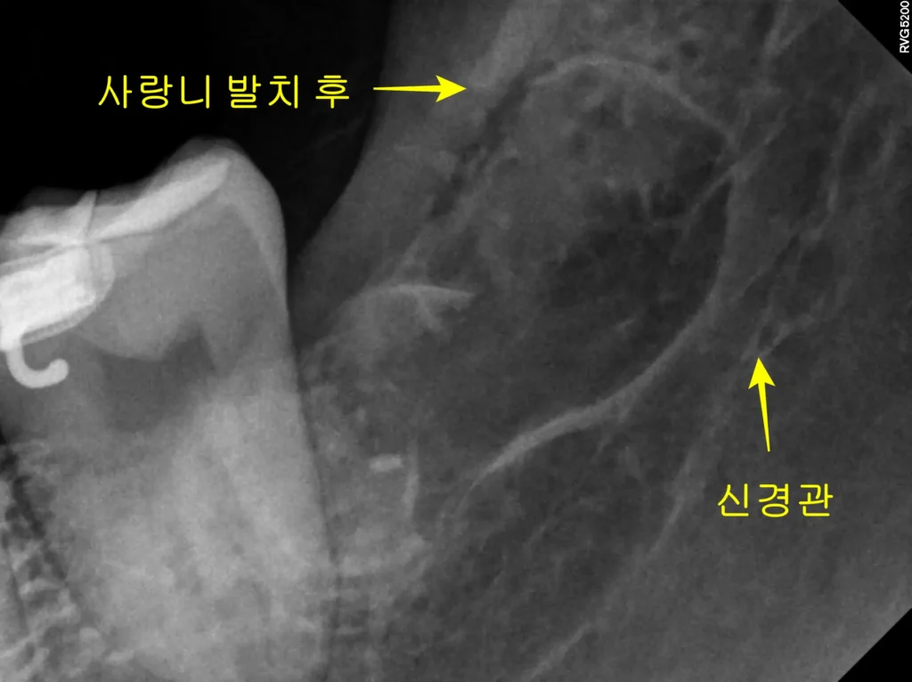 교정 중 사랑니 발치 후 P.A view