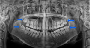 초진 파노라마 사진(사랑니 4개 하루에 발치)