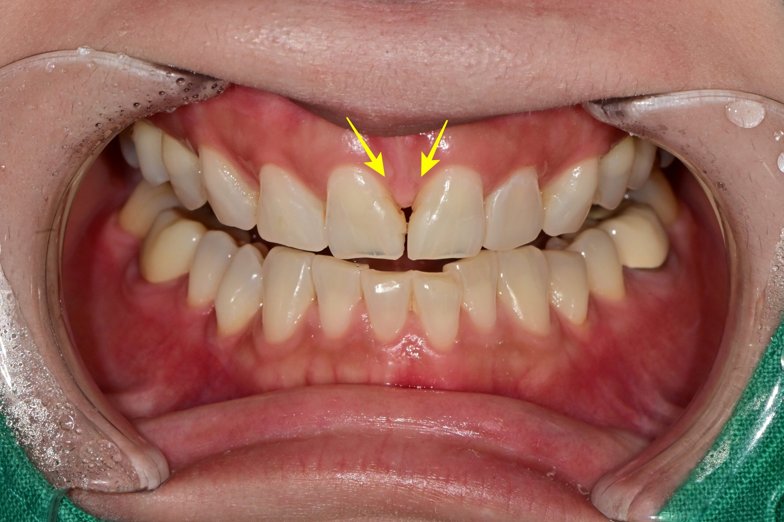 변색된 앞니 레진 및 치아 미백 증례