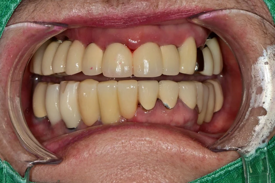 최종 보철 완성 구내 정면 - 임플란트 치료 결과