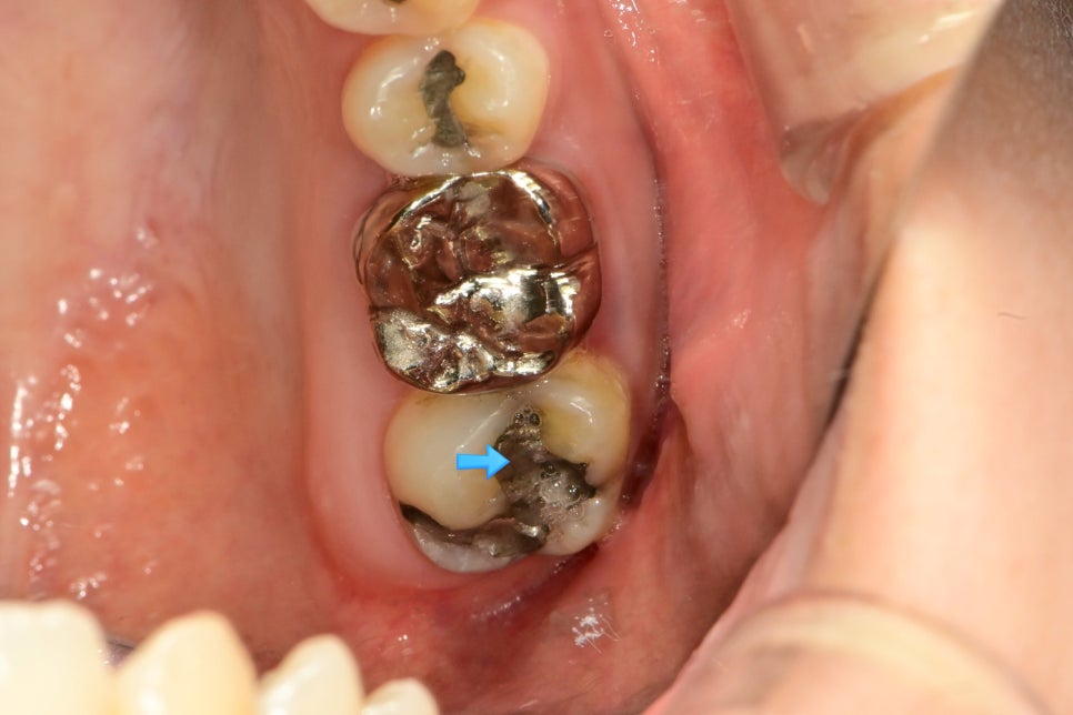 우측 구치부 근접 임상사진 — 아말감 경계 파절과 변색 부위에 화살표 표시