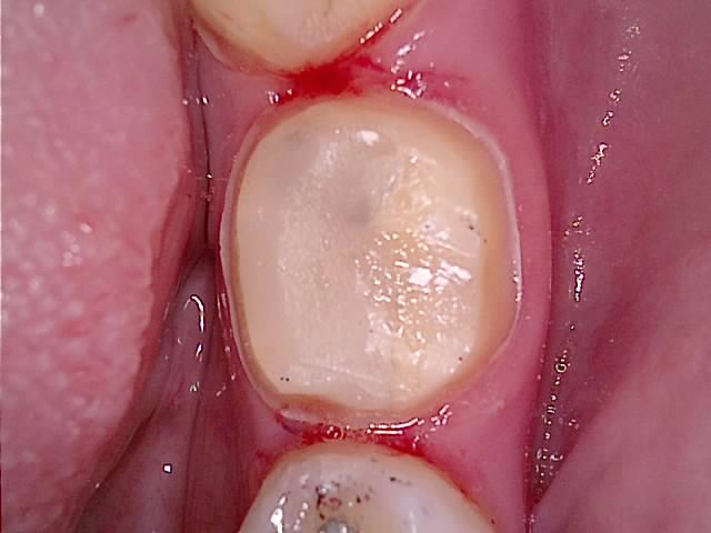 아말감 제거 후 깨끗하게 형성된 와동 임상사진 — 아말감 하방 상태 확인