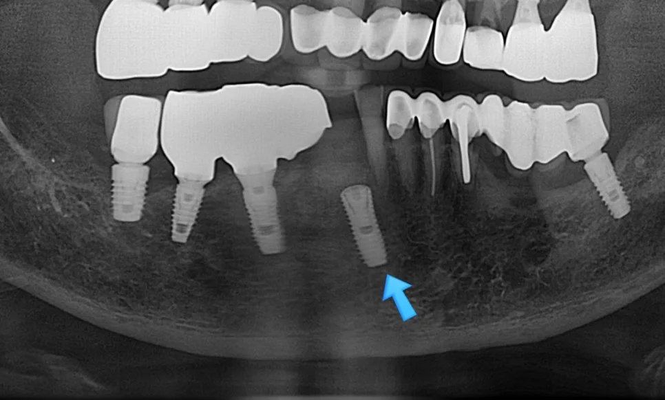치료 전 파노라마 X-ray – 임플란트 및 보철 문제 부위 진단