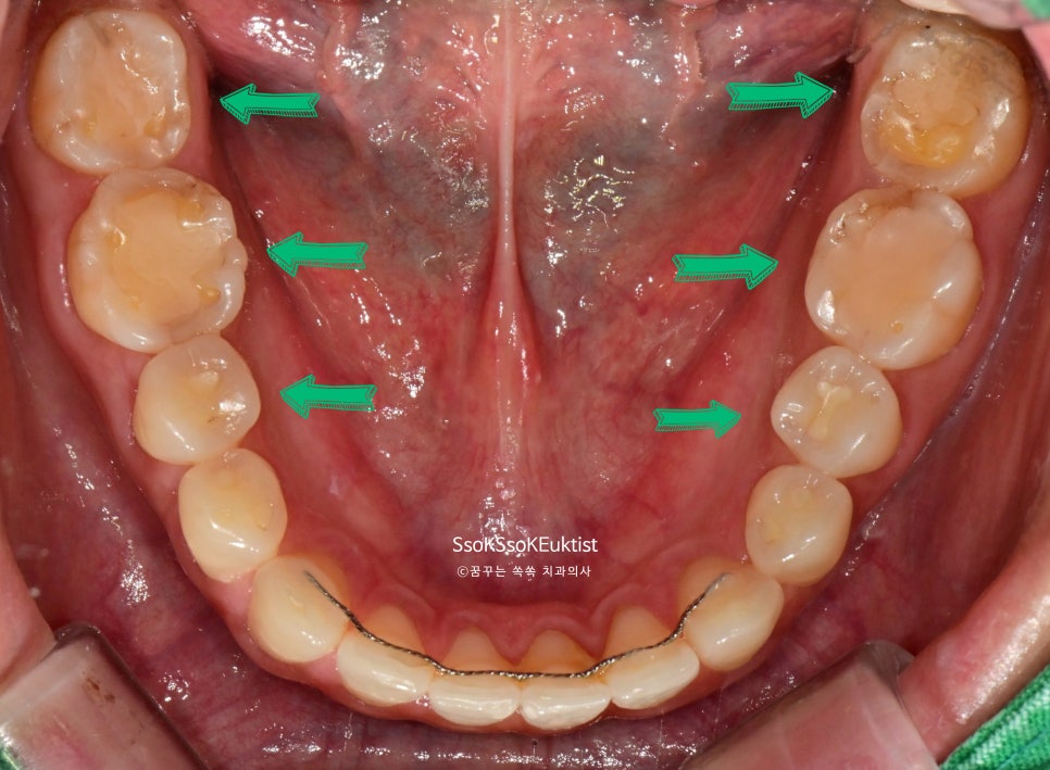 이갈이 측방력으로 인한 치아 마모 패턴