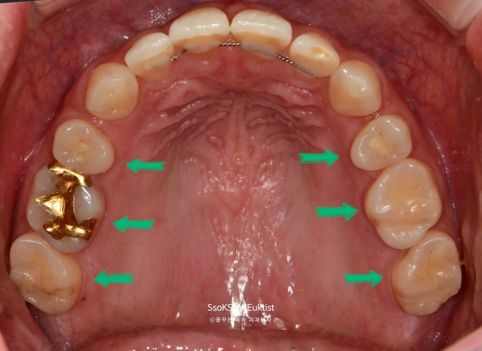 이갈이 환자 다수 어금니 마모 - 상아질 광범위 노출