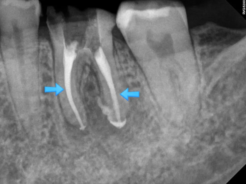 재신경치료 후 신경관 충전이 완료된 엑스레이