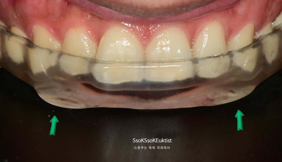 완성된 하드 스플린트 - 송곳니 라이즈 확인