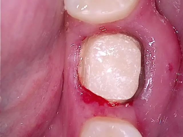 크라운 수복을 위한 코어 빌드업 과정