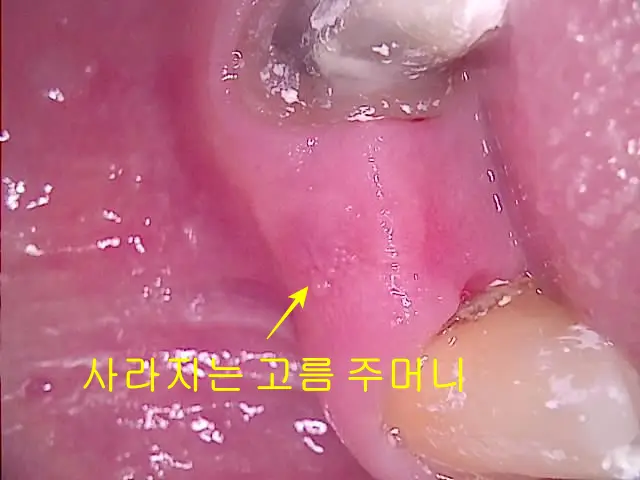 재신경치료 중간에 사라지고 있는 고름 주머니 모습