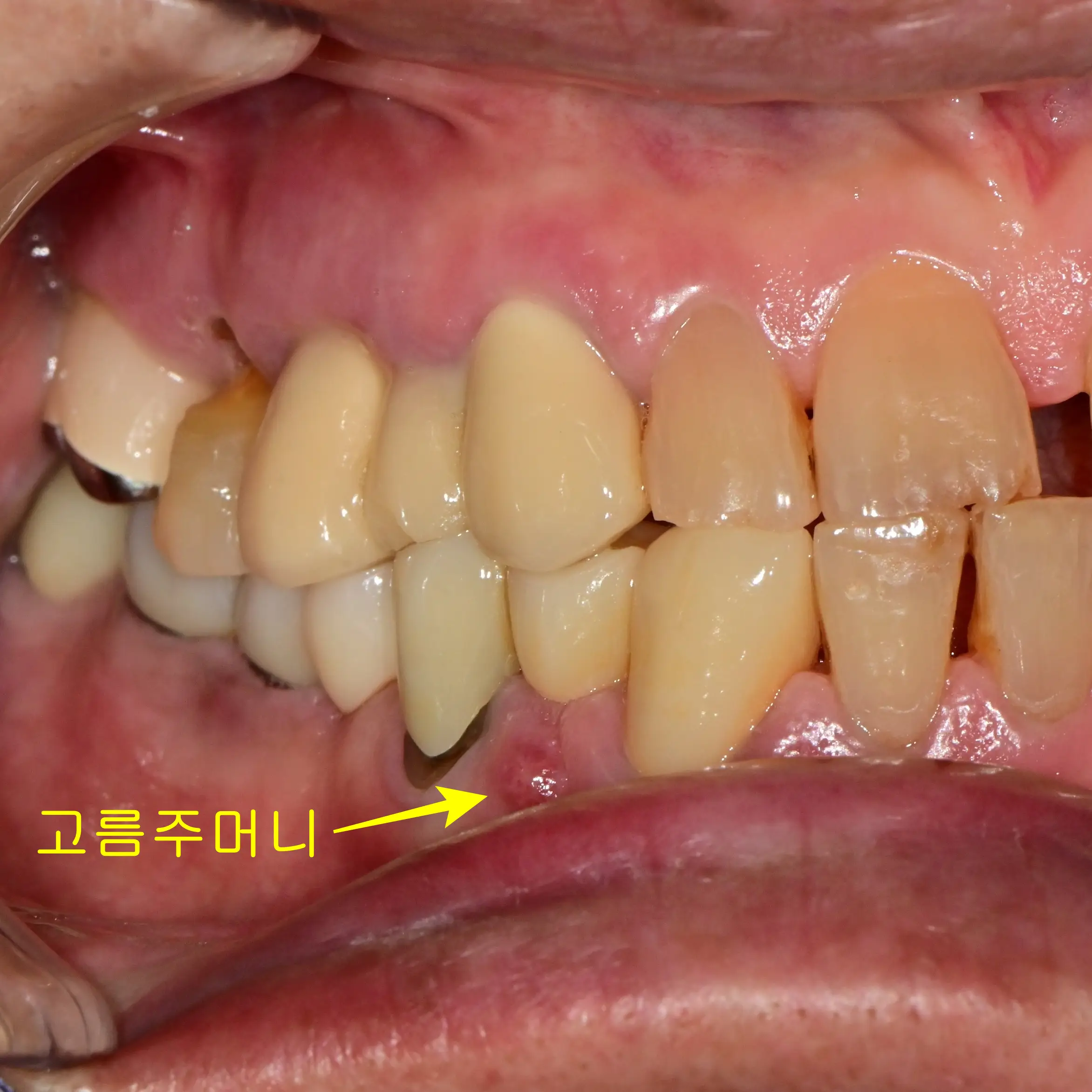 고름주머니가 잡힌 오래된 브릿지 재신경치료 측면 사진