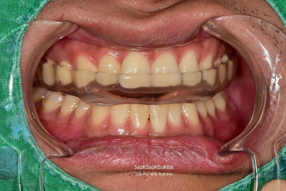 하드 타입 이갈이 스플린트 나이트가드 장치