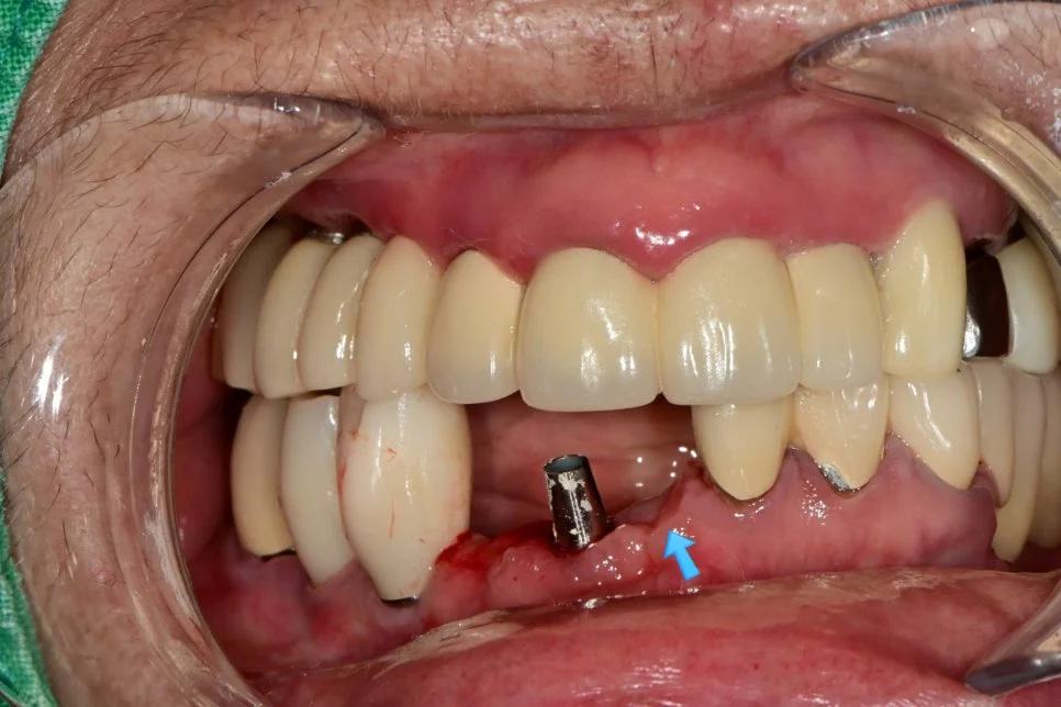 임플란트 힐링 어버트먼트 노출 - 잇몸 치유 후 상태
